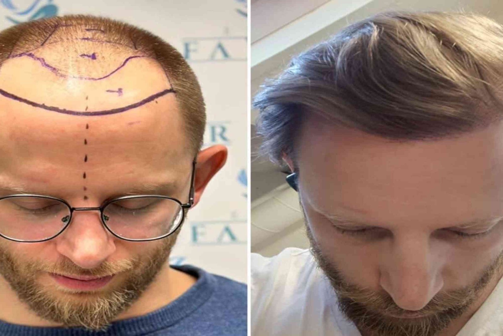 Hair Transplant Turkey